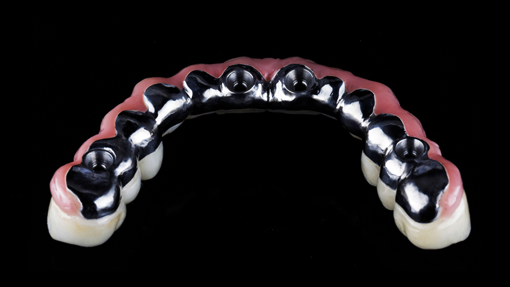 black dental model of the jaw with a bridge prosthesis and zirco