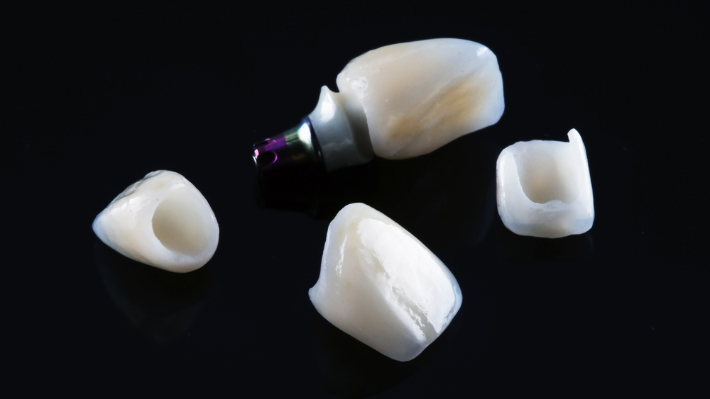 Dental-Tech-Team_Service_implants_custom-abutments